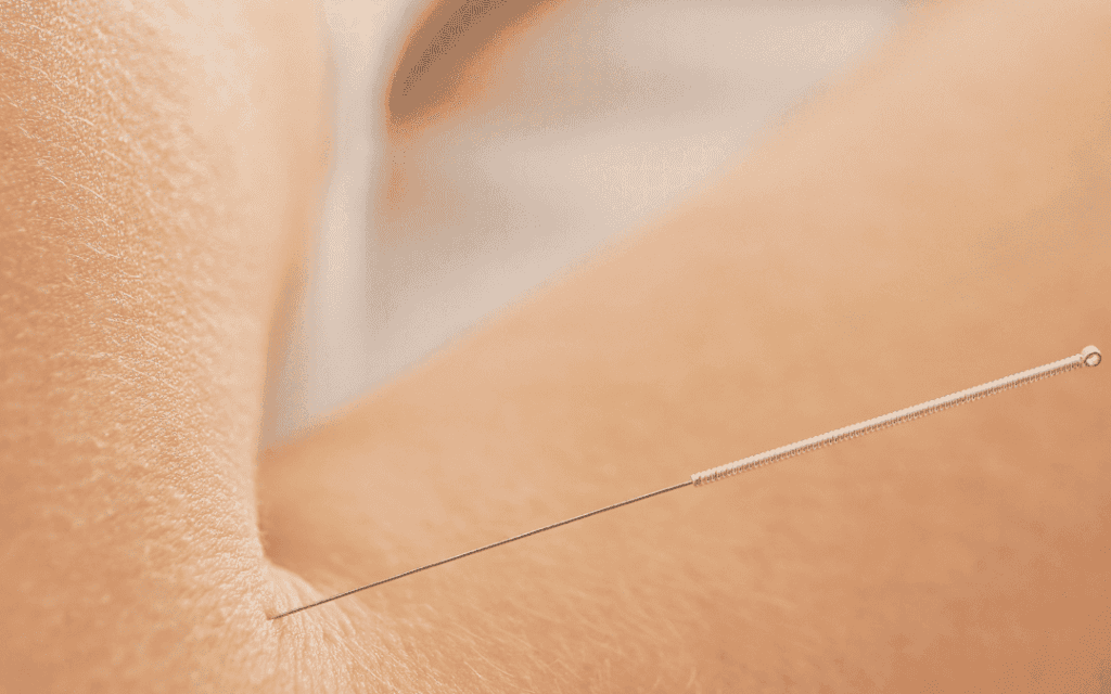 Close up of dry needling