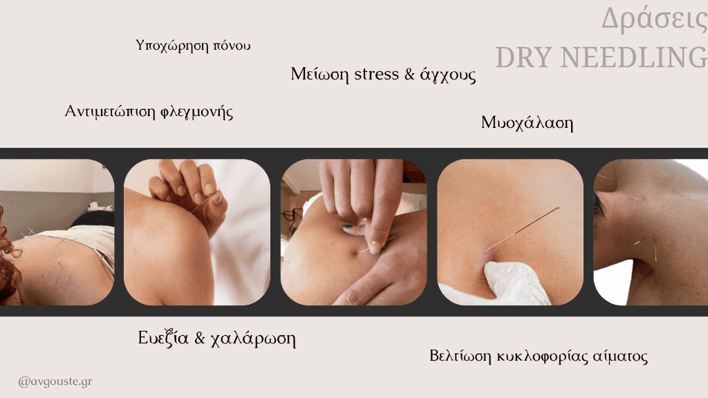 Το Dry Needling στην ανακούφιση του πόνου